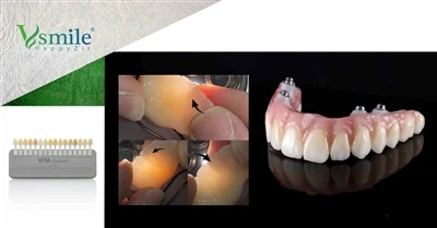Brud og deformation under tandbehandling